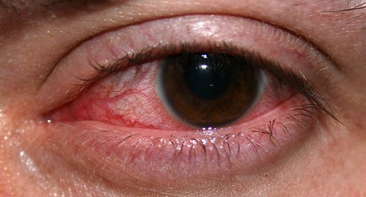 Acanthamoeba Keratitis